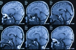 Washington DC Traumatic Brain Injury Attorney