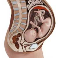 Breech Birth