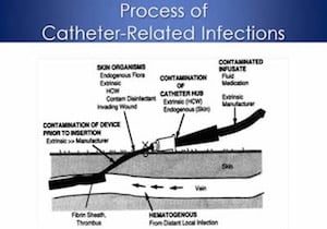 catheterinfections