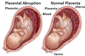 placental_abruption_imagetwo