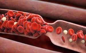 Venous Thrombosis (Blood Clots)