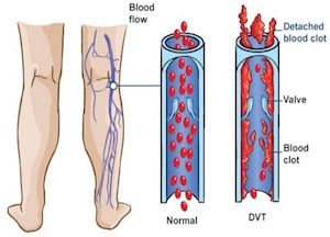 venousthrombosis